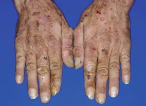 Porphyria