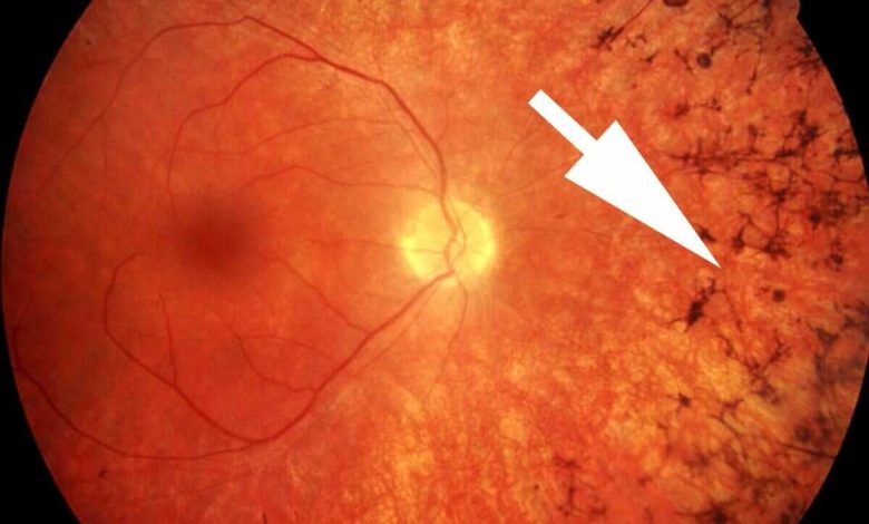 Retinitis Pigmentosa