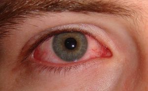 Sjogren’s Syndrome