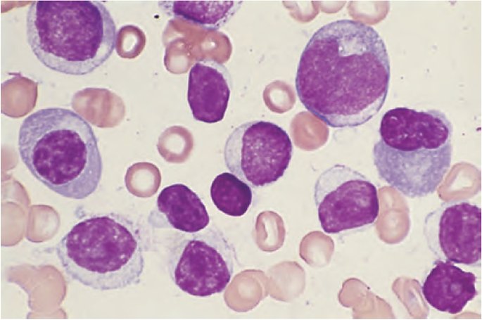 Waldenstrom’s Macroglobulinemia