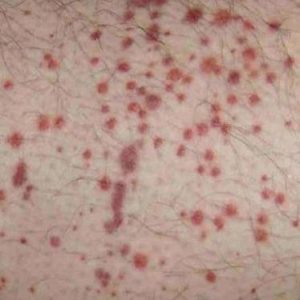 Idiopathic Thrombocytopenic Purpura Symptoms, Causes, Diagnosis and ...