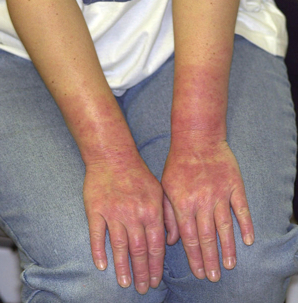 Latex Allergy Symptoms Causes Diagnosis And Treatment Natural 