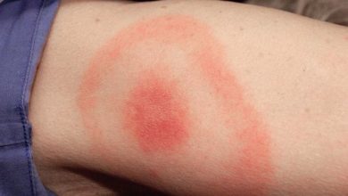 lyme disease