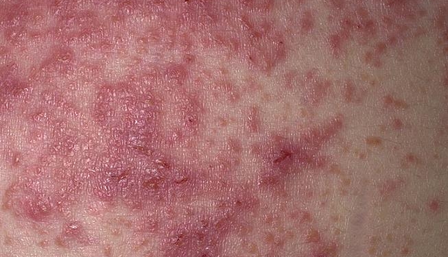 Dermatitis Herpetiformis Symptoms Causes Diagnosis And Treatment