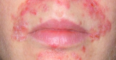 Periodontitis Symptoms, Causes, Diagnosis and Treatment 