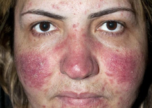 Por que sale la rosacea