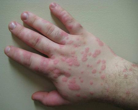 Valley Fever Symptoms, Causes, Diagnosis and Treatment ...