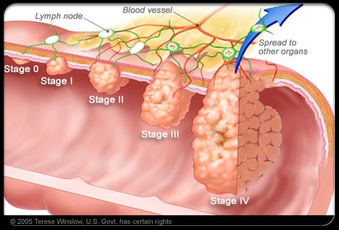 Colon Cancer Symptoms, Causes, Diagnosis and Treatment - Natural Health ...