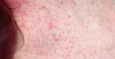 Natural Treatment Rheumatic Fever Natural Treatment Rheumatic Fever
