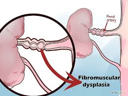 Renal Artery Stenosis