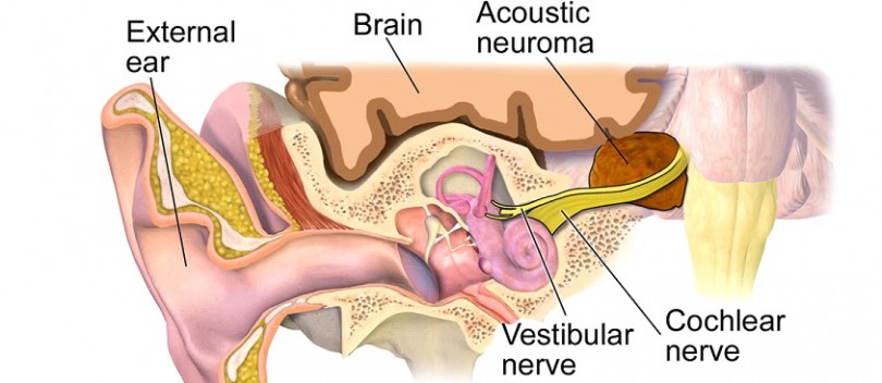 Natural Remedies For Brain Tumors Natural Remedies For Brain Tumors