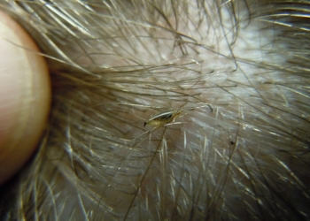 Lice