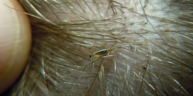 Lice