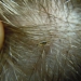 Lice