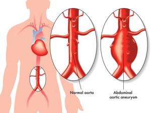 Abdominal Aortic Aneurysm