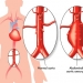 Abdominal Aortic Aneurysm