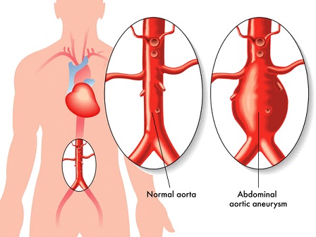 Abdominal Aortic Aneurysm