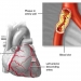 Acute Coronary Syndrome