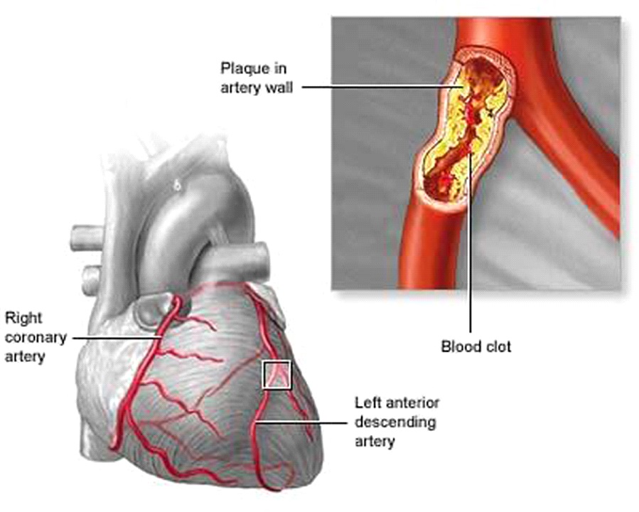 Acute Coronary Syndrome