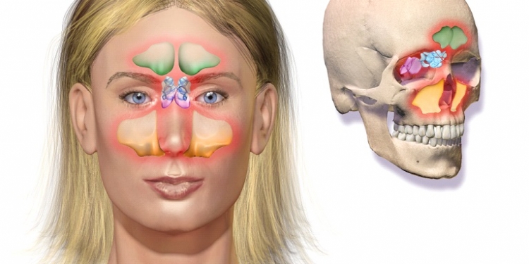 Acute Sinusitis