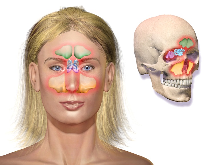 Acute Sinusitis