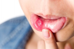 Behcet’s Disease