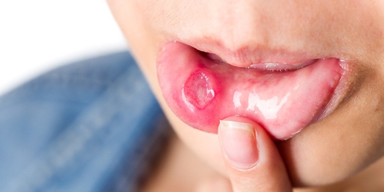 Behcet’s Disease