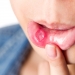 Behcet’s Disease