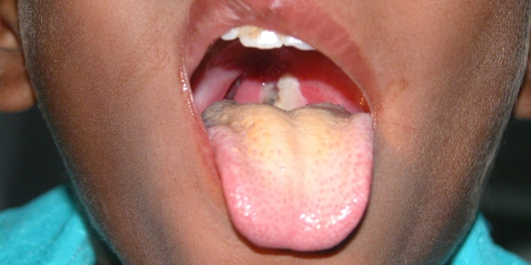 Diphtheria