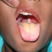 Diphtheria