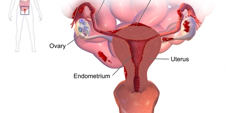 Endometriosis