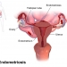 Endometriosis