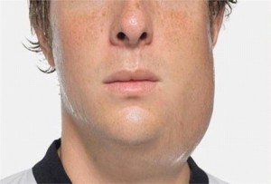 Mumps