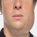 Mumps