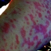 Penincillin Allergy