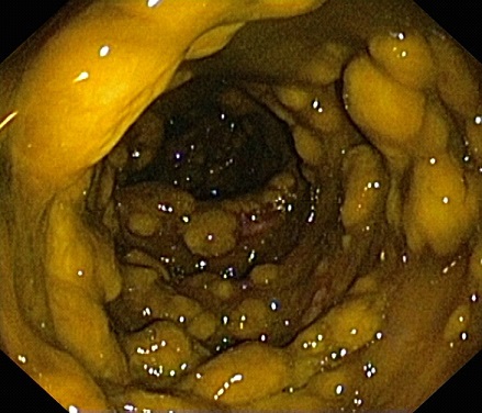 Pseudomembranous Colitis