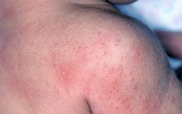 Sun Allergy