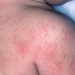 Sun Allergy