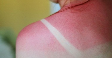 delayed sunburn reaction