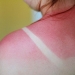 Sunburn