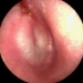 Acute Otitis Media