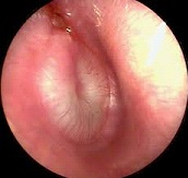 Acute Otitis Media