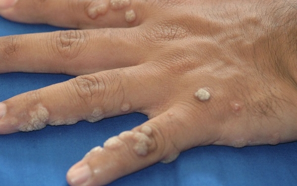 Common Warts