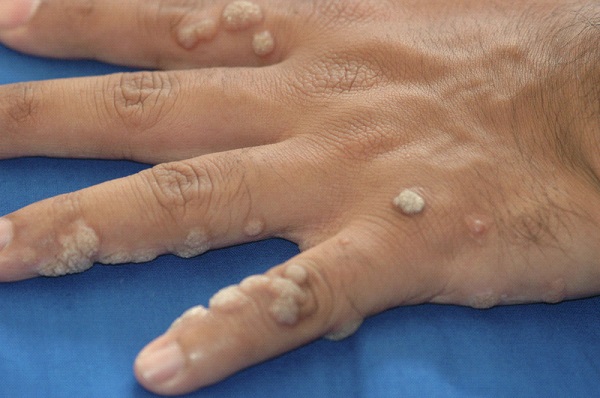 Common Warts