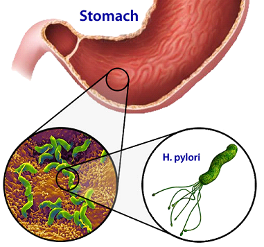 H.Pylori Infection