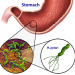 H.Pylori Infection
