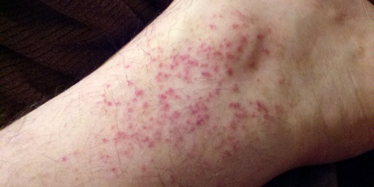 Heat Rash