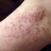 Heat Rash