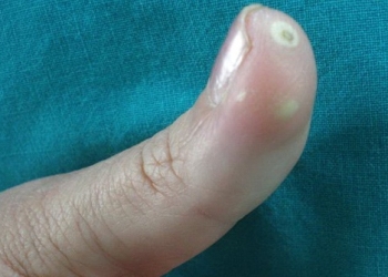 Limited Scleroderma