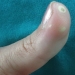 Limited Scleroderma